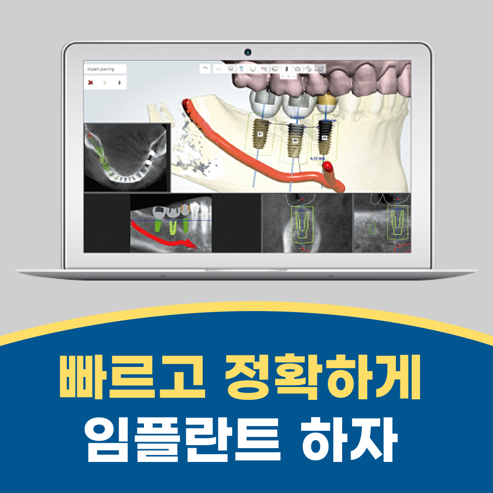 컴퓨터 분석 임플란트